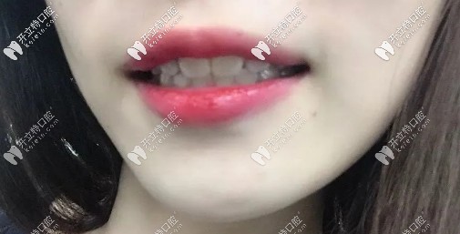 矯正后的效果圖，略微有點(diǎn)內(nèi)頃