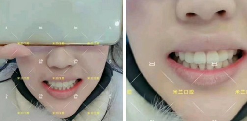 直到多生牙把門牙都擠變形了，才決定拔牙帶3M自鎖牙套矯正