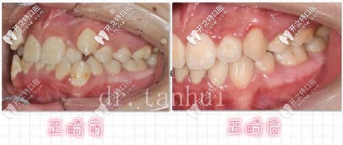 北京維樂口腔正畸案例 側面