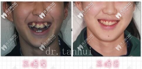 牙齒不整齊亂成這樣,自鎖直絲弓矯正后只想說(shuō)一句,真牛