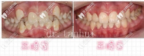 北京維樂口腔骨性一類錯頜畸形矯治案例