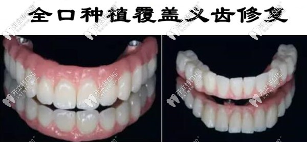 全口種植覆蓋義齒圖片
