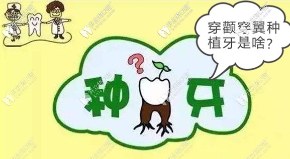 關于穿顴穿翼板種植牙技術的風險和效果,你了解多少