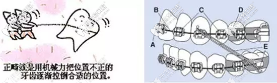 正畸中弓絲的種類(lèi)有哪些