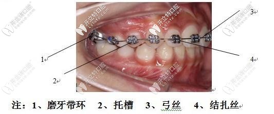 begg細(xì)絲弓矯治前牙擁擠