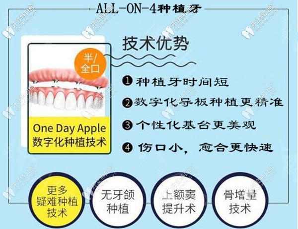 海口鼎點(diǎn)口腔allon4全口半口種植牙技術(shù)