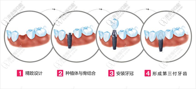 裝假牙哪種材料好