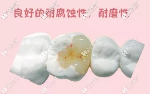 嵌體補牙