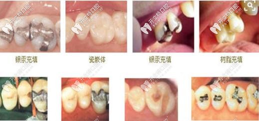 補牙材料種類