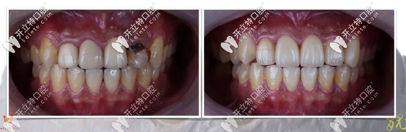 海口微笑口腔烤瓷牙換全瓷牙真人案例