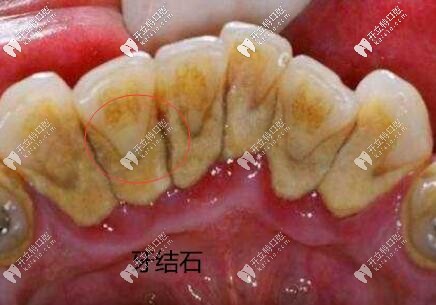 潔牙98起,國(guó)產(chǎn)全瓷牙888起,安康私人連鎖口腔收費(fèi)價(jià)格表盤(pán)點(diǎn)