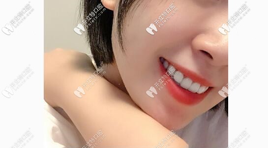 門牙種植牙后