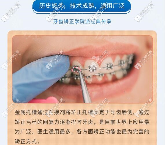 鋼絲金屬托槽牙齒矯正價(jià)格