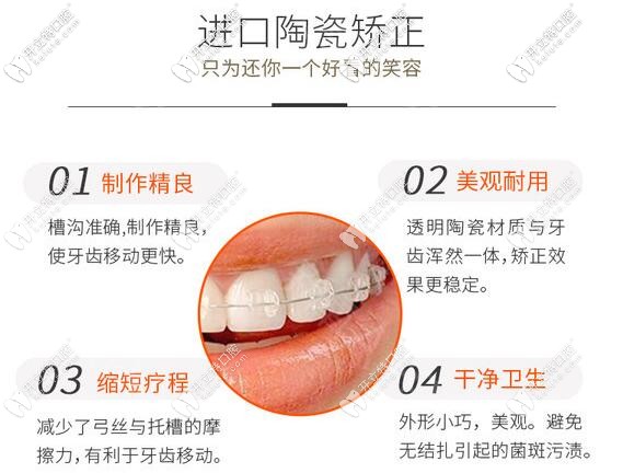 陶瓷半隱形托槽的優(yōu)勢(shì)