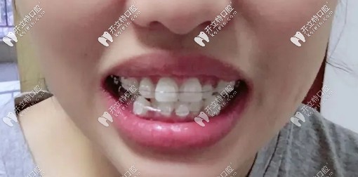 戴陶瓷自鎖托槽中期，牙齒已經(jīng)開始慢慢歸位