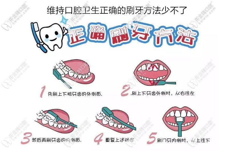 作為一個做了種植牙的過來人建議大家一定要注意口腔衛(wèi)生