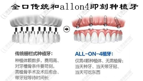 全口傳統(tǒng)種植牙和allon4即刻負重種植牙