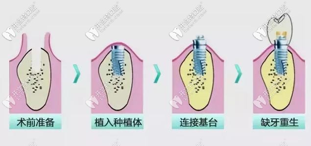 種植牙的過(guò)程