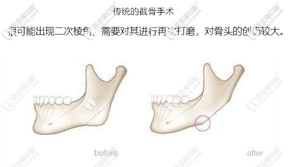 做之前要對目前主流的正頜手術(shù)方法進(jìn)行了解