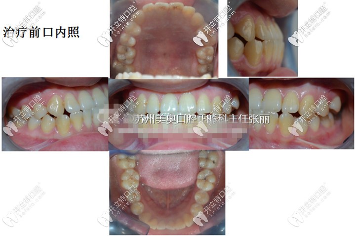 附上治療前的口內照——上頜、左側面和右側面、下頜