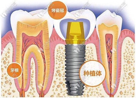為什么種植牙價格相差那么大，區(qū)別究竟在哪里？
