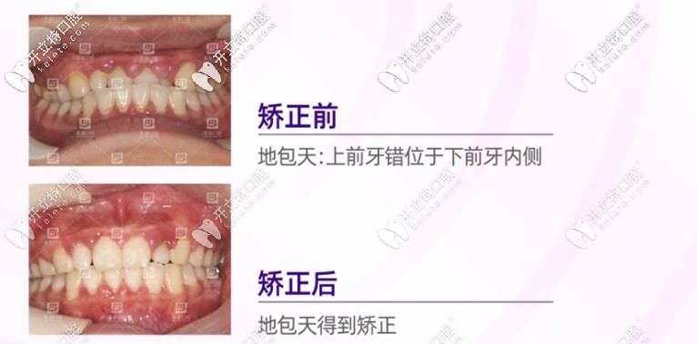 重慶美奧口腔地包天矯正案例