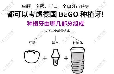 德國(guó)Bego種植體