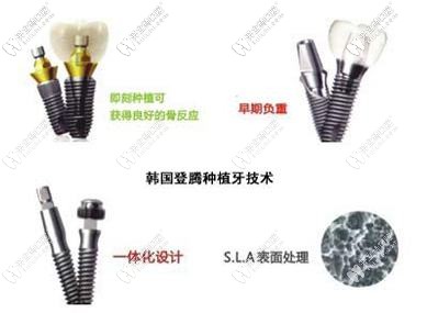 登騰種植體的設(shè)計(jì)