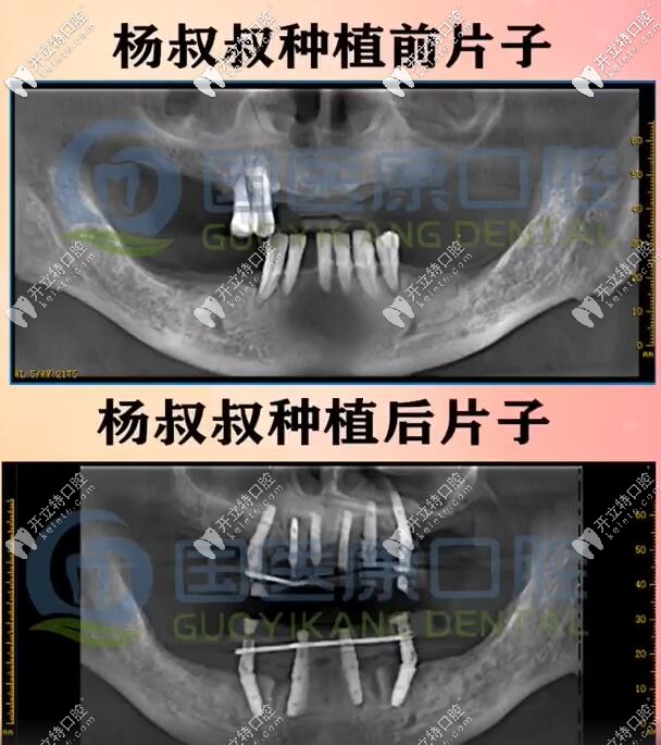 71歲楊叔做一日得全口種植牙種了10顆植體，上半口6下半口4