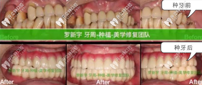 無錫美奧口腔重度牙周炎患者種牙前后對(duì)比照片