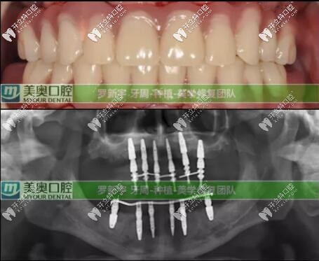 無錫美奧口腔牙周炎種植6個(gè)月后口內(nèi)情況