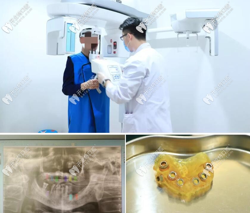 張大爺種牙前的CBCT檢查和3D數(shù)字化導(dǎo)板