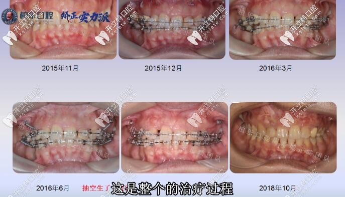 南寧柏樂后牙缺失三顆大牙案例整個治療過程