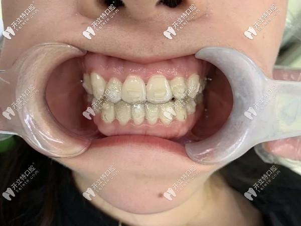 戴時代天使隱形牙套做牙齒矯正到一半懷孕了