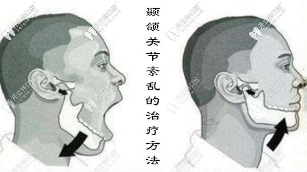 顳下頜關節(jié)紊亂的治療方法