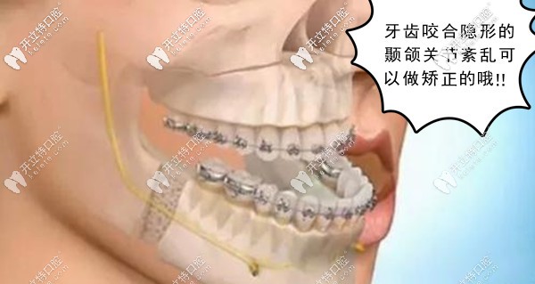 顳下頜關節(jié)紊亂能做牙齒矯正嗎