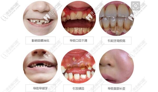 牙齒不齊的危害