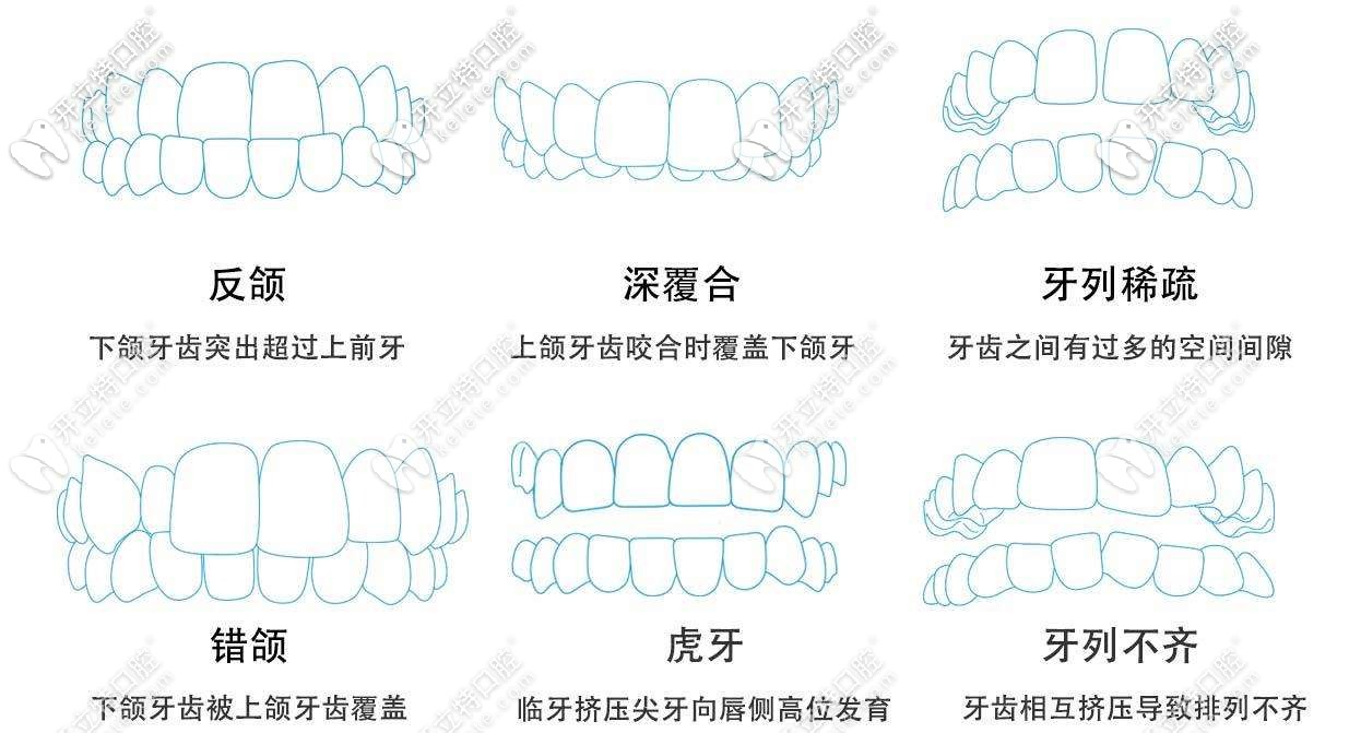 青少年牙齒矯正適應(yīng)癥