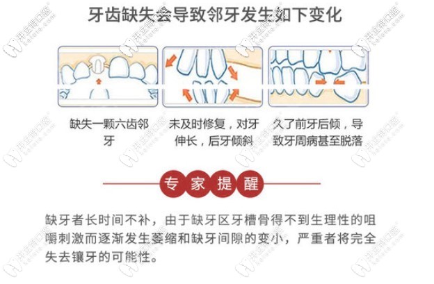 尹靜波主任提醒，長(zhǎng)時(shí)間缺牙危害很大