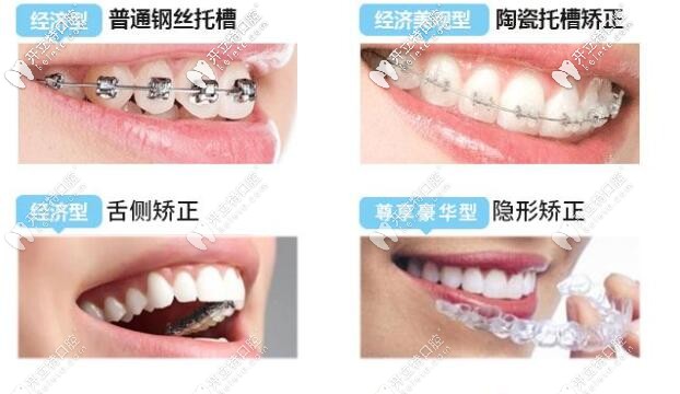 牙套種類