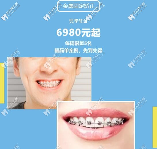 暑期學(xué)生做金屬托槽矯正多少錢(qián)呢?憑學(xué)生證享鋼牙套6980元啦