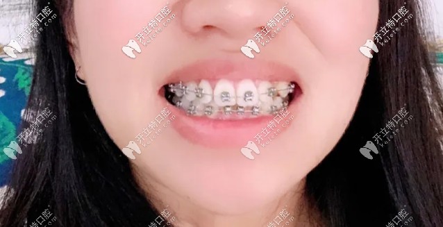 快該摘掉牙套啦，牙齒已經(jīng)排齊了