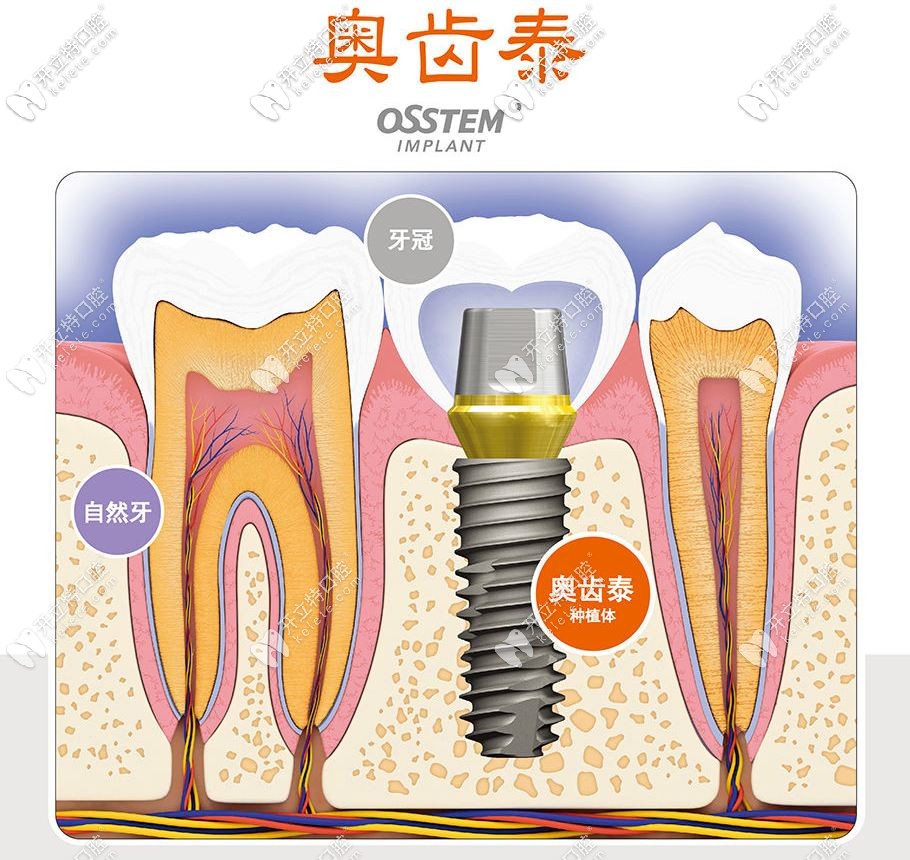 種植體也有粗細之分,那奧齒泰種植體的粗度是多少你造嗎