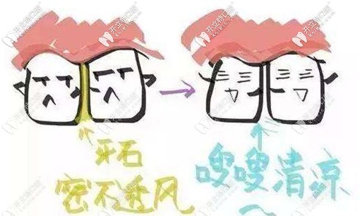 每年定期潔牙可以預防牙縫大