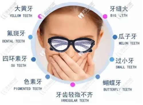 牙齒貼面可以改善九大牙齒問題