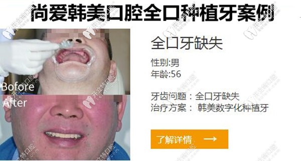 昆明尚愛韓美口腔全口種植牙案例