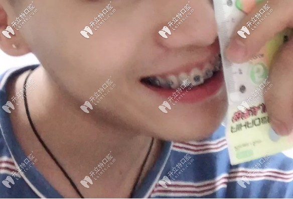 真是后悔沒早點(diǎn)做深覆蓋矯正