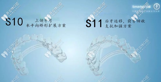 S10、S11牙弓重塑隱形技術(shù)