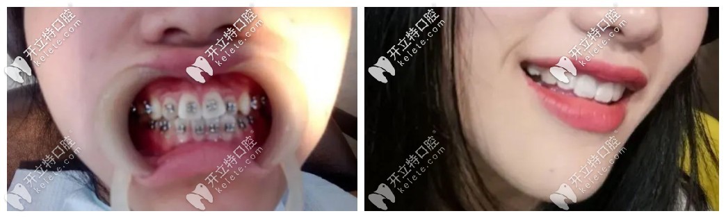 門牙有點外凸可以做國產(chǎn)普特第五代自鎖托槽來矯正哦