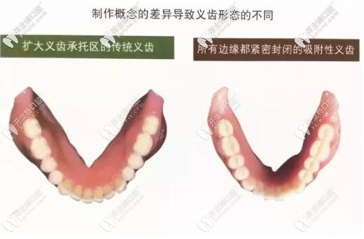 bps全口吸附性義齒和普通假牙的區(qū)別